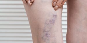 수술을 받지 않고 정맥류를 제거하라는 스페인 혈관학회의 조언